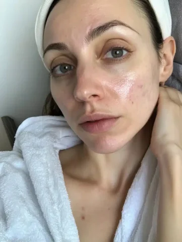 Casual iPhone Portrait of Skin — Midjourney v6 AI Prompt: A photo depicting the problematic facial skin of a 30-year-old woman. The photo...